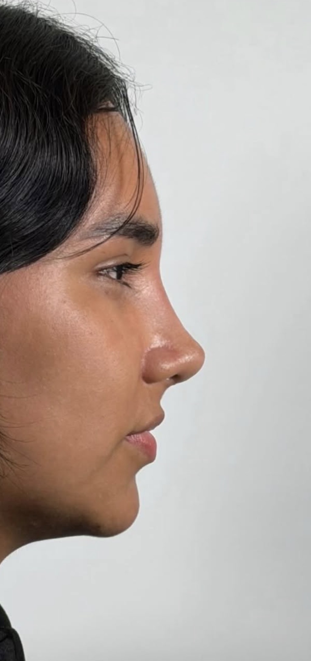 Rinoplastia estructural ultrasónica — después