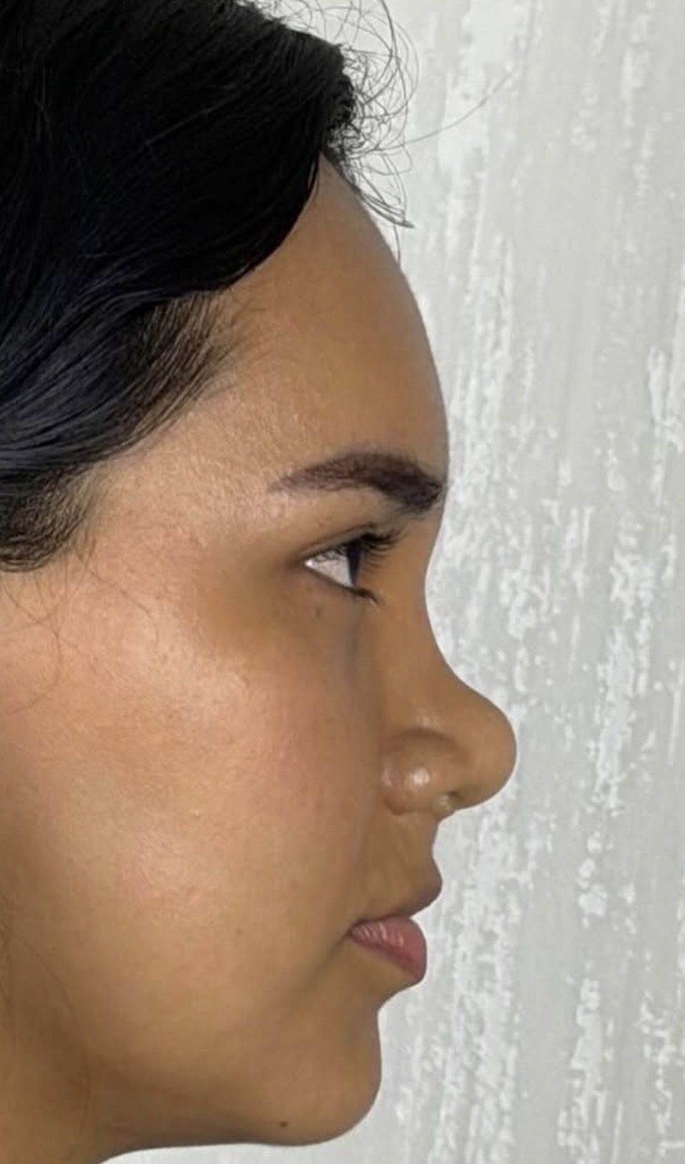 Rinoplastia estructural ultrasónica — antes