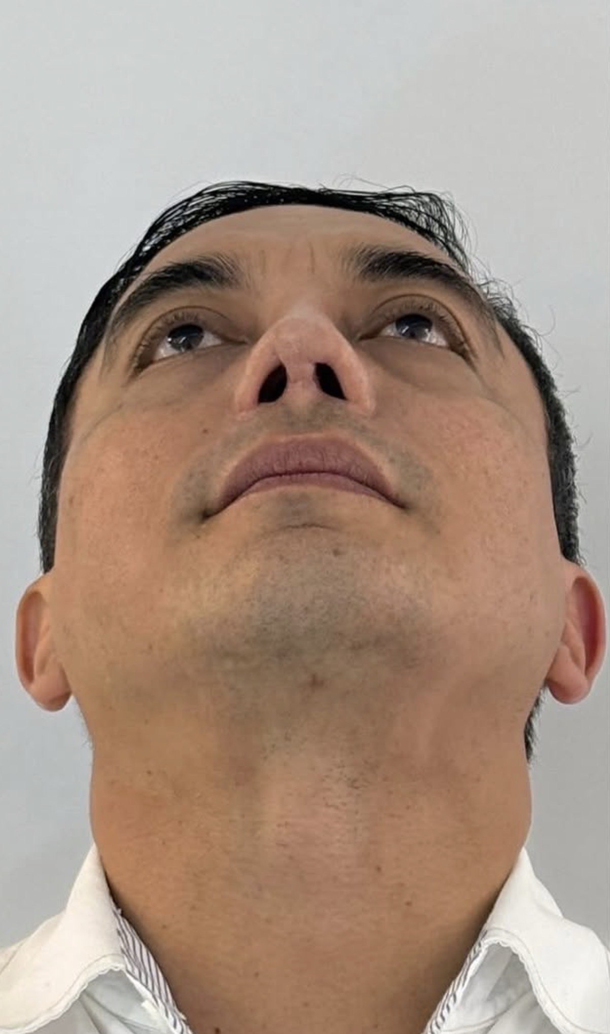 Rinoplastia estructural ultrasónica — después