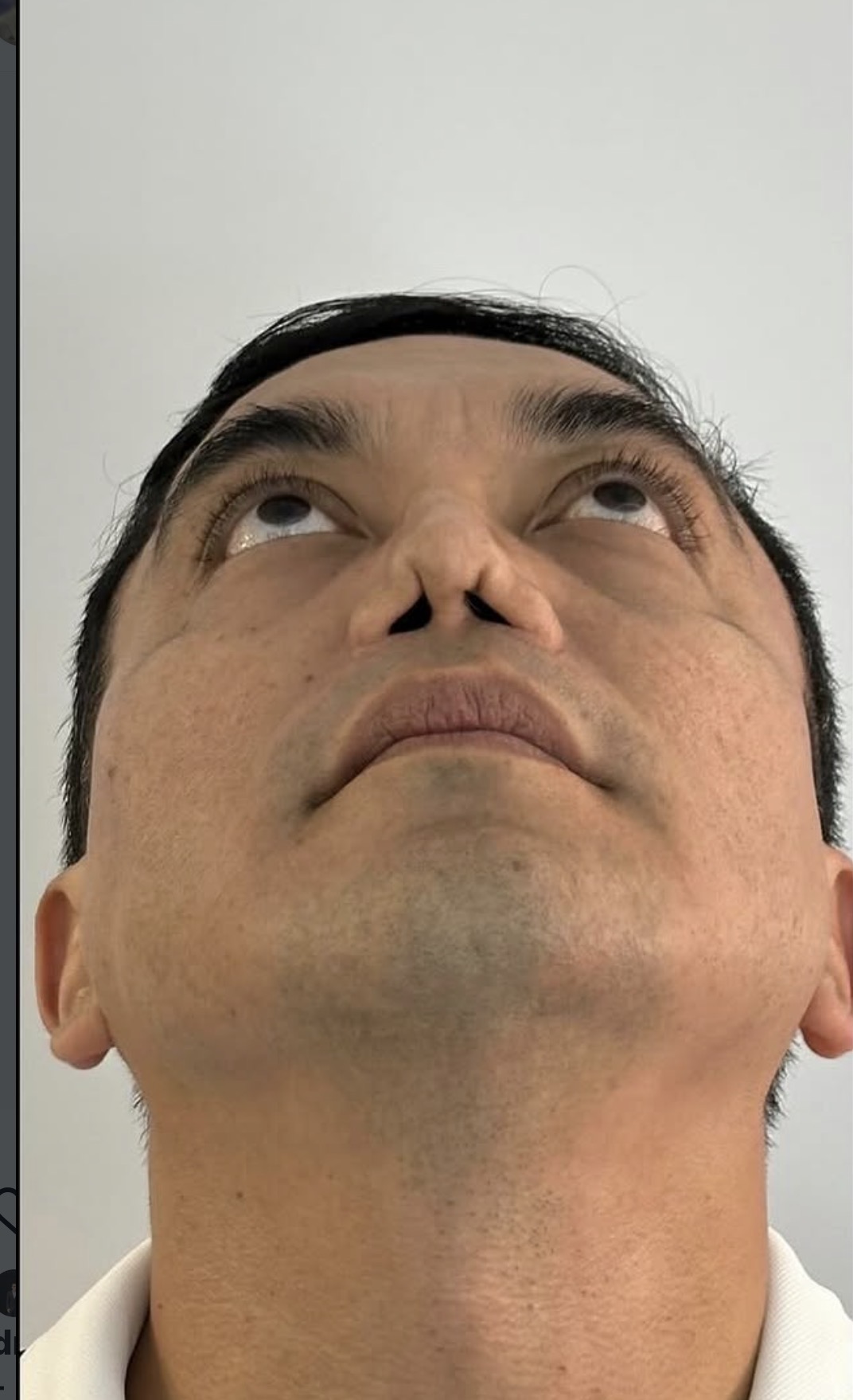 Rinoplastia estructural ultrasónica — antes