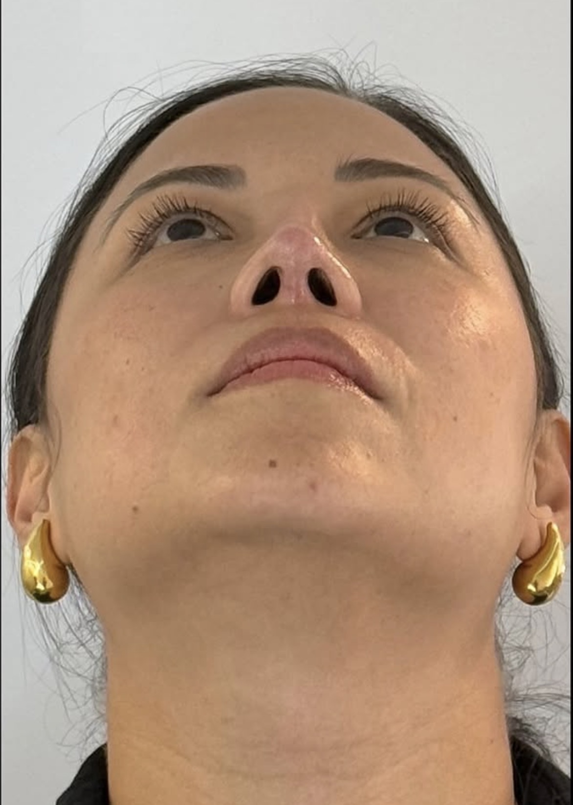 Rinoplastia estructural ultrasónica — después