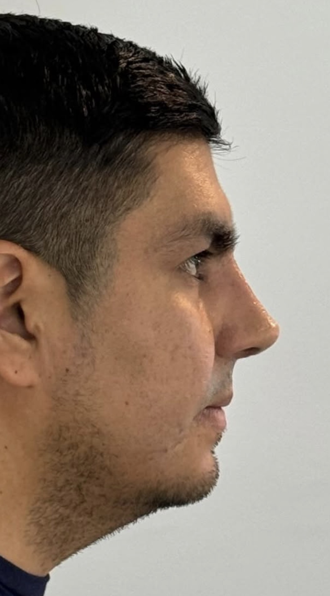 Rinoplastia estructural ultrasónica — después