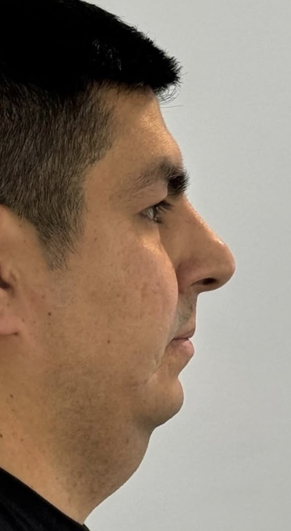 Rinoplastia estructural ultrasónica — antes