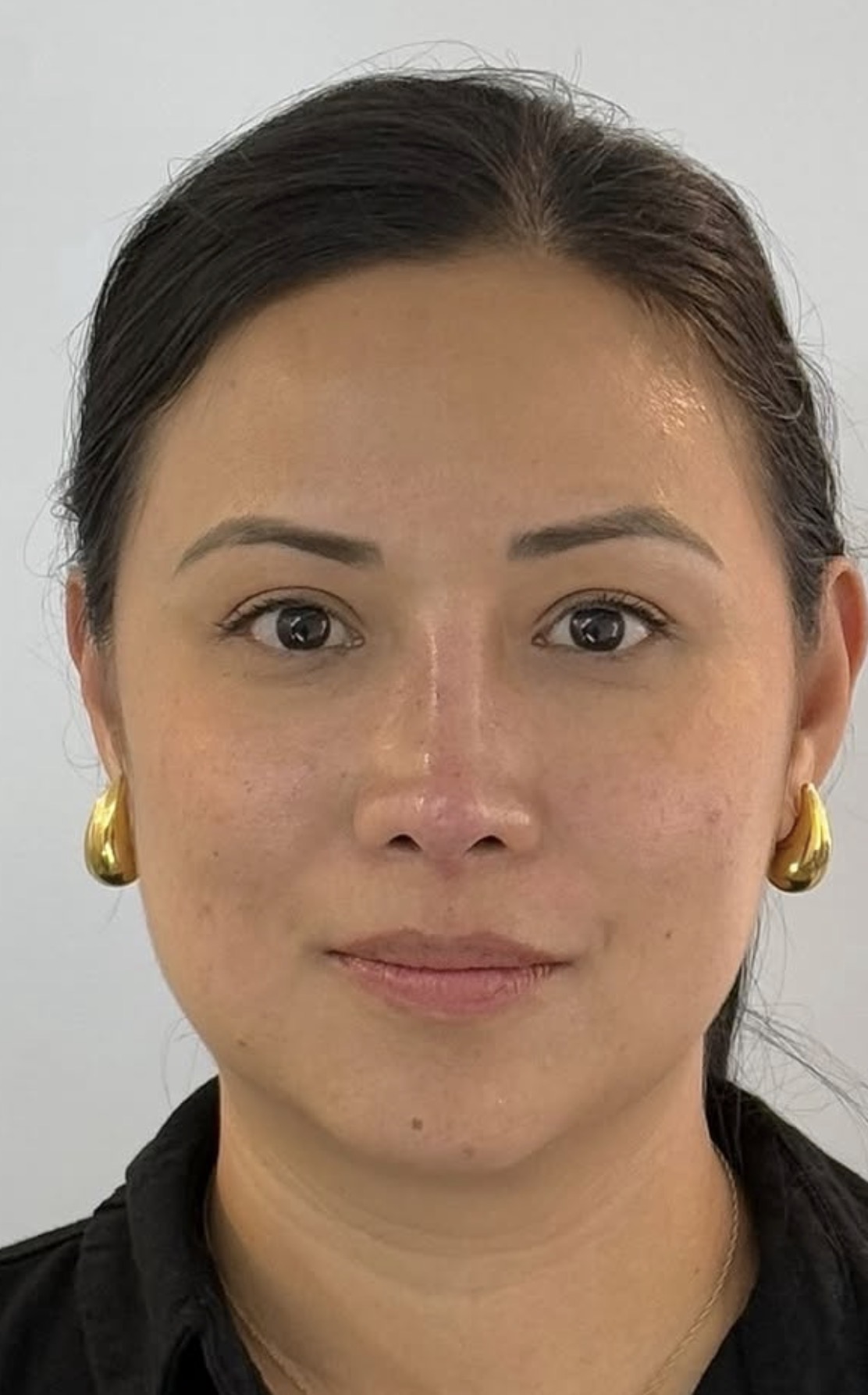 Rinoplastia estructural ultrasónica — después