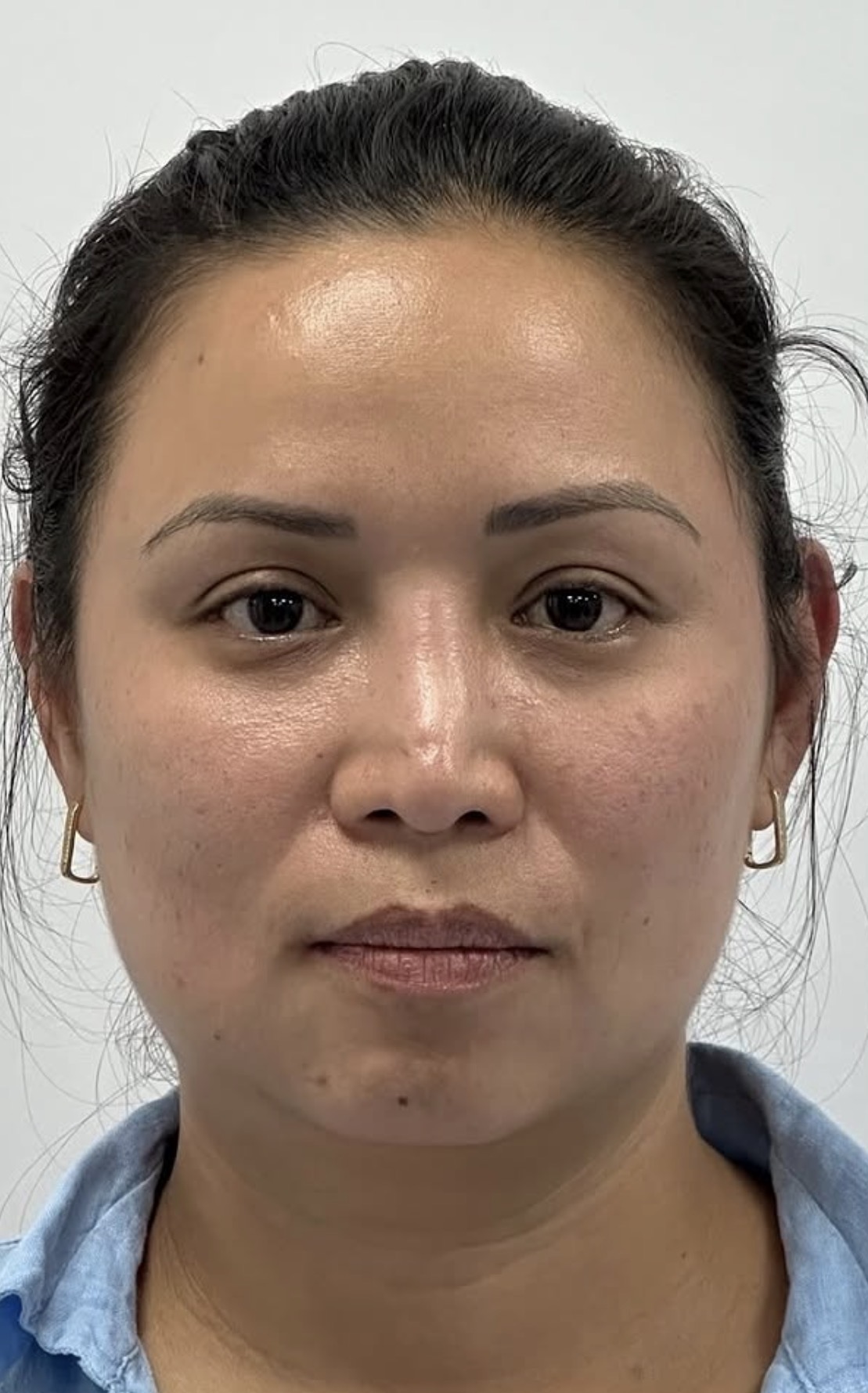 Rinoplastia estructural ultrasónica — antes