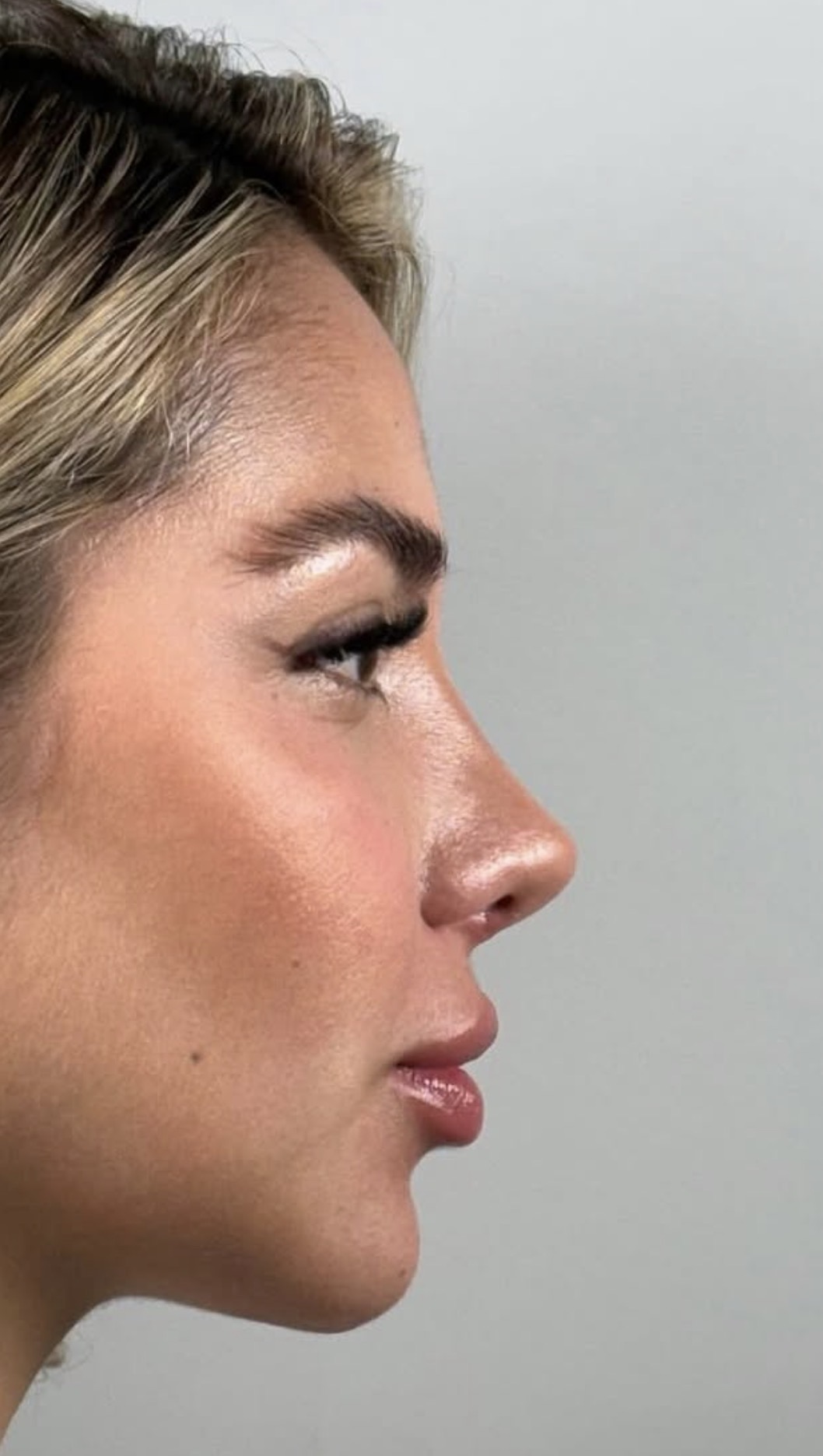 Rinoplastia estructural ultrasónica — después