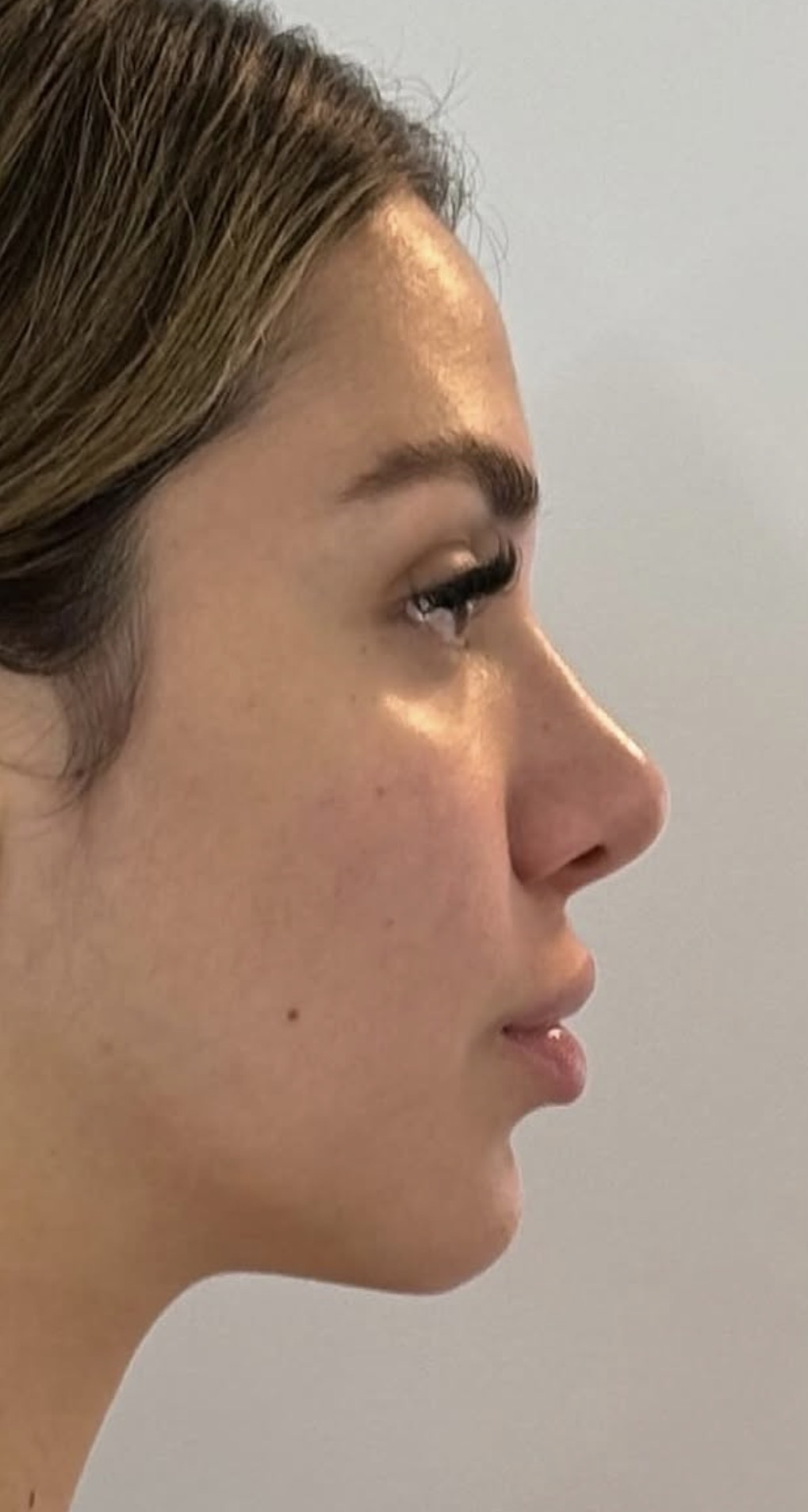 Rinoplastia estructural ultrasónica — antes