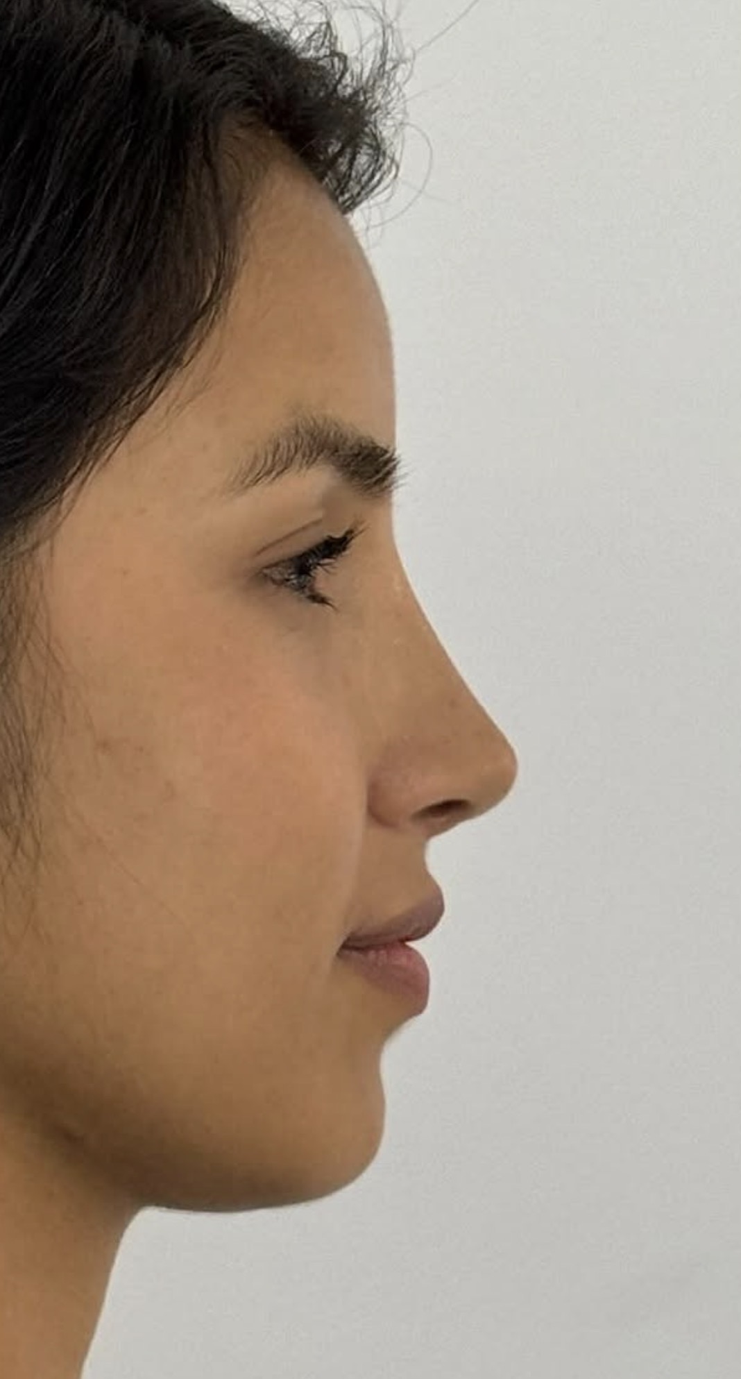 Rinoplastia estructural ultrasónica — después