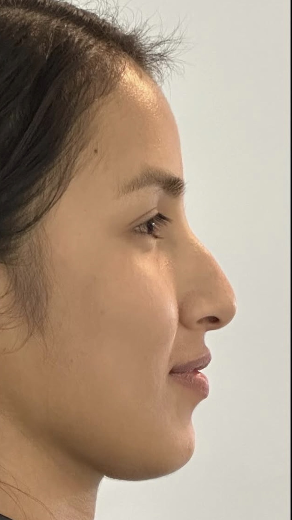 Rinoplastia estructural ultrasónica — antes