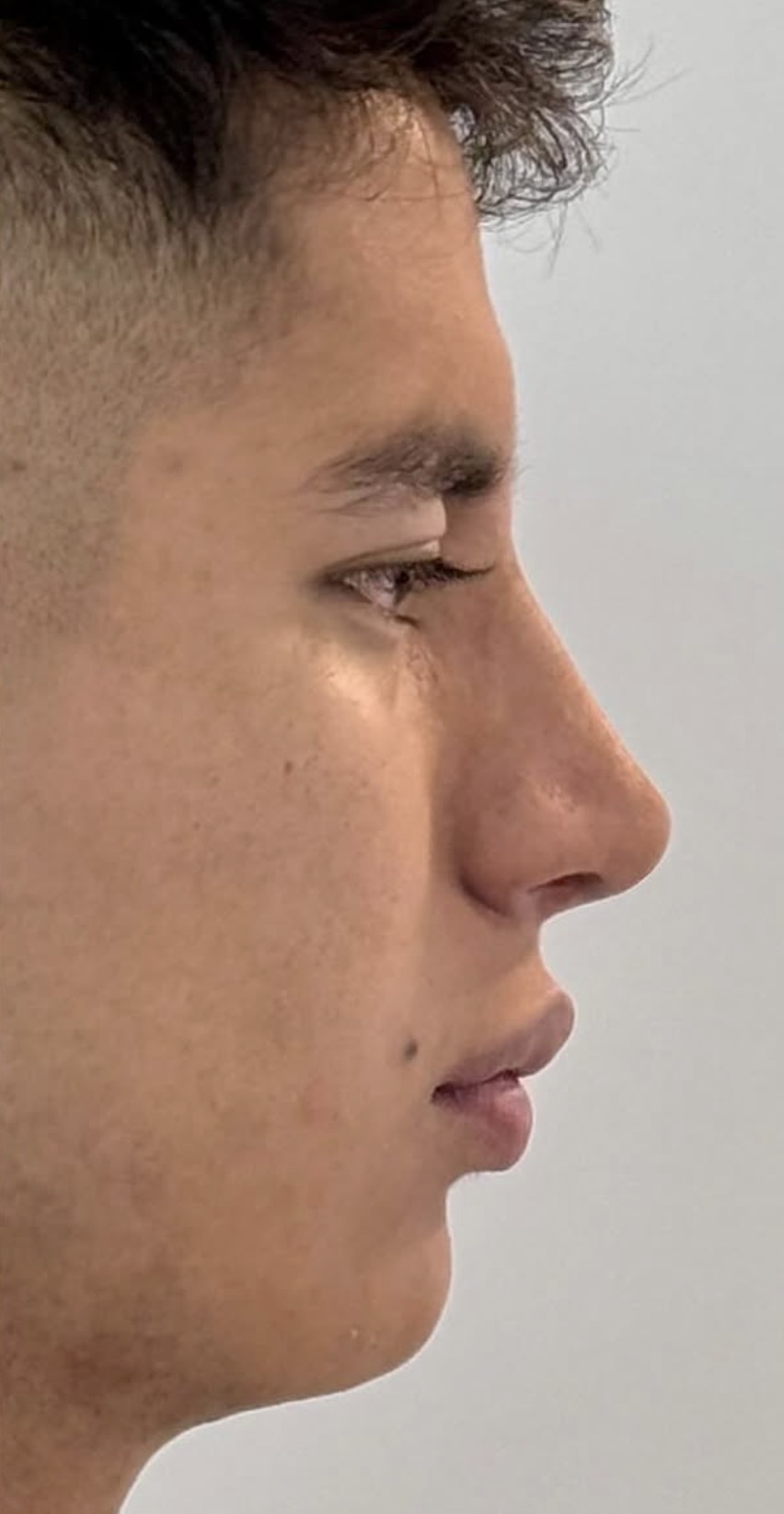 Rinoplastia estructural ultrasónica — después