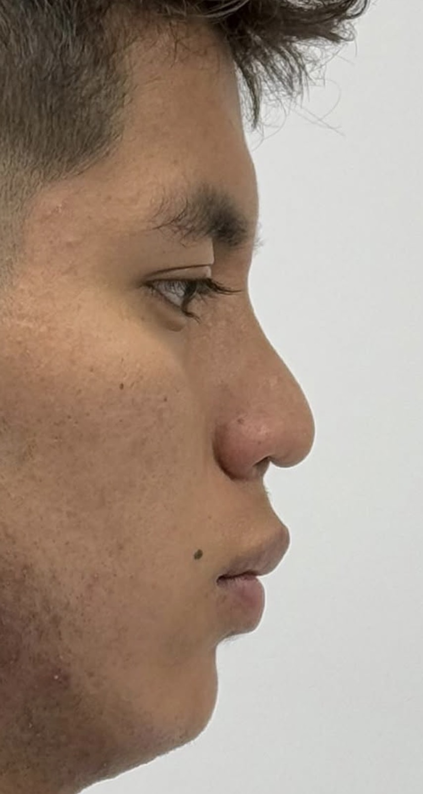 Rinoplastia estructural ultrasónica — antes