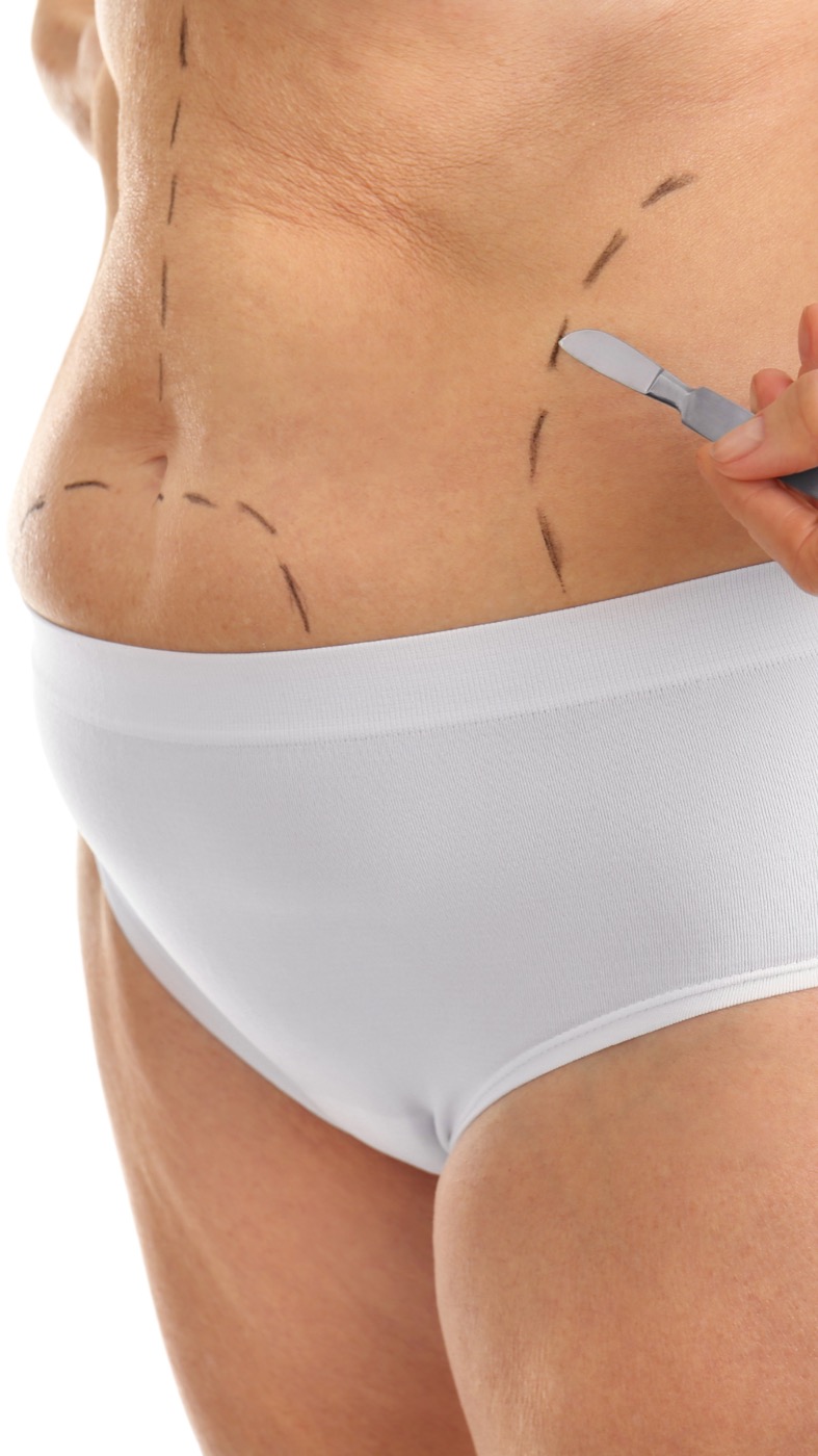 Lipoabdominoplastia — marcación quirúrgica previa